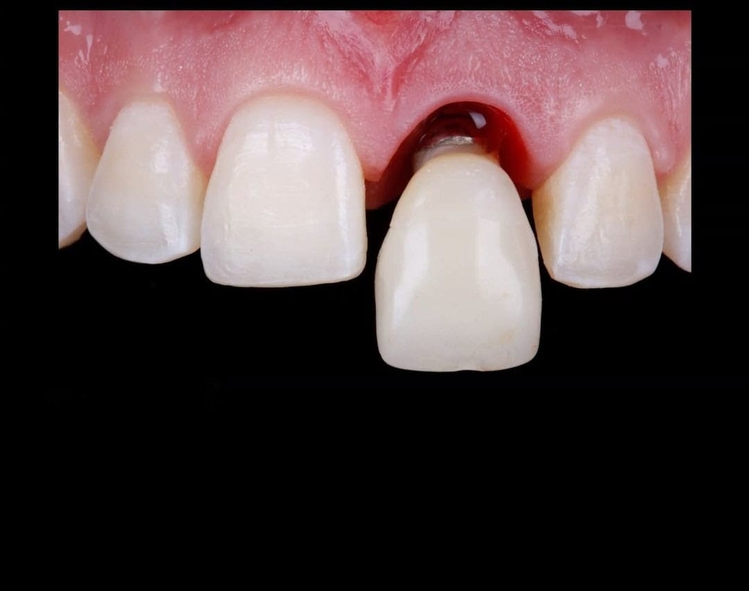 Resultado de implante dental con apariencia natural en Diamante Clínica Dental